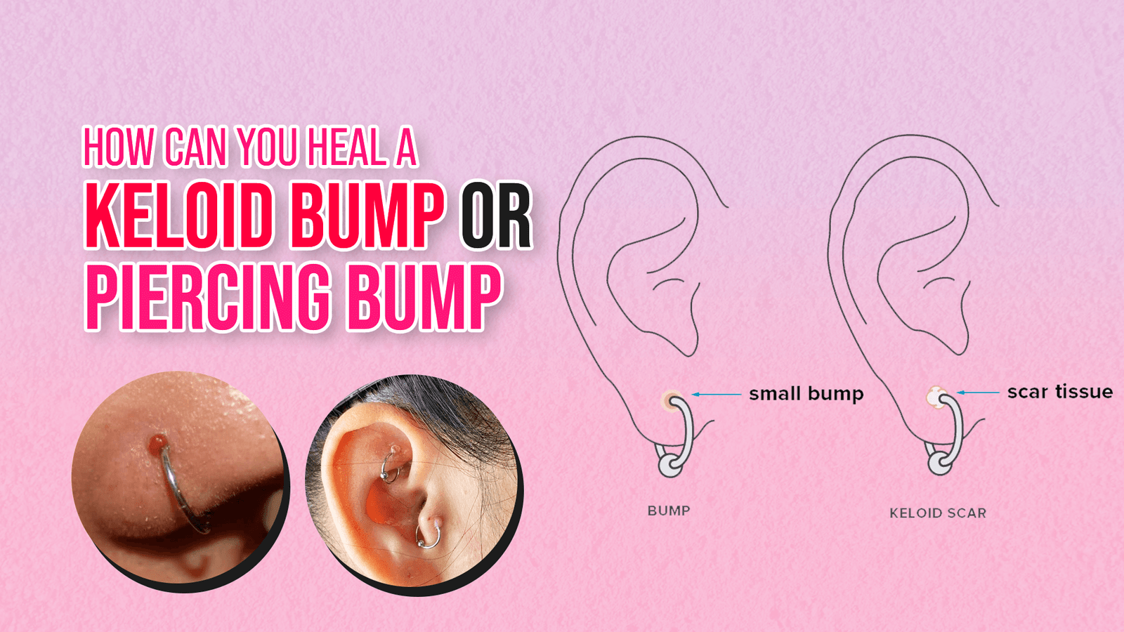 How Can You Heal a Keloid Bump or Piercing Bump
