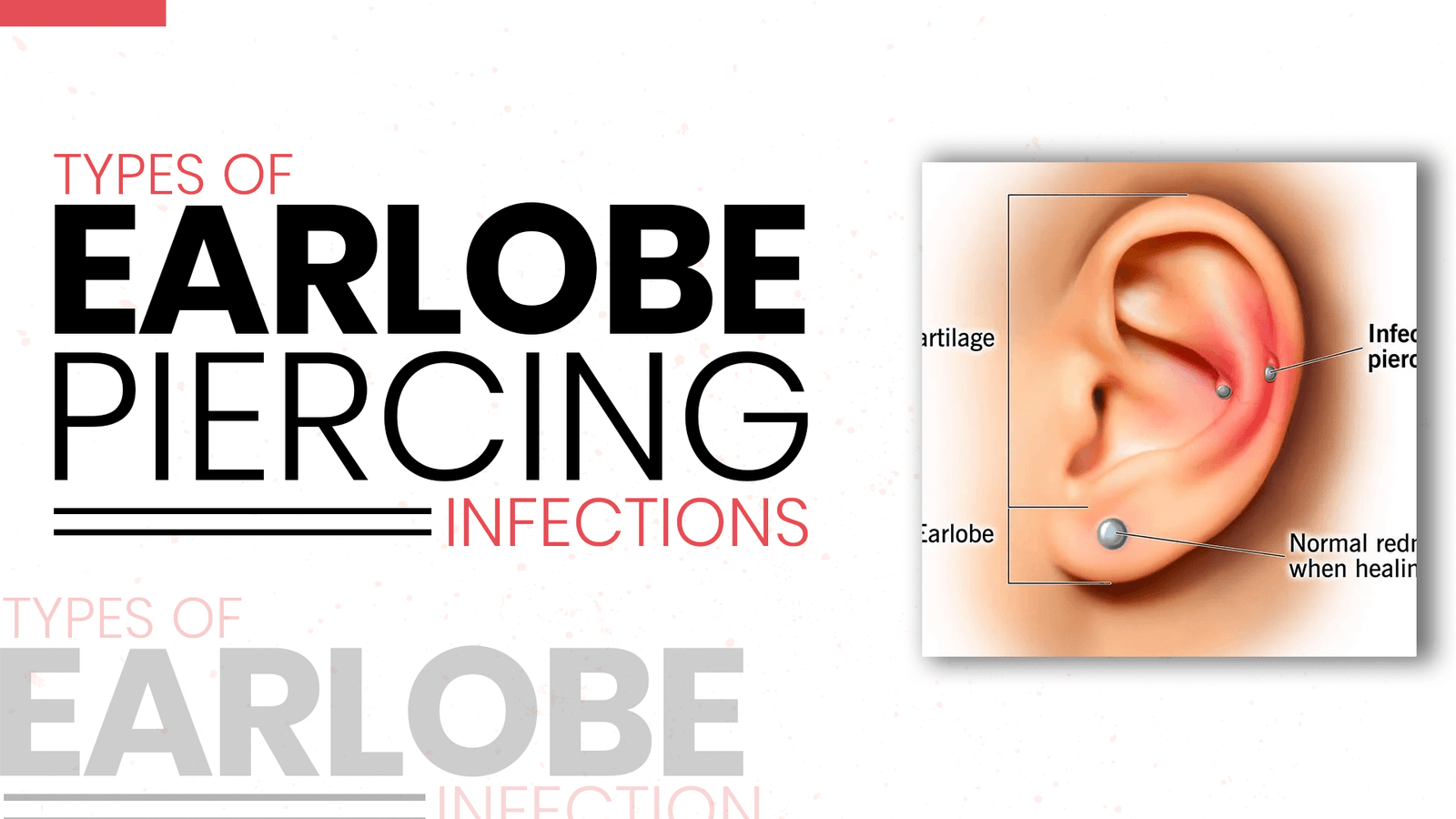 Types-of-Earlobe-Piercing-Infections